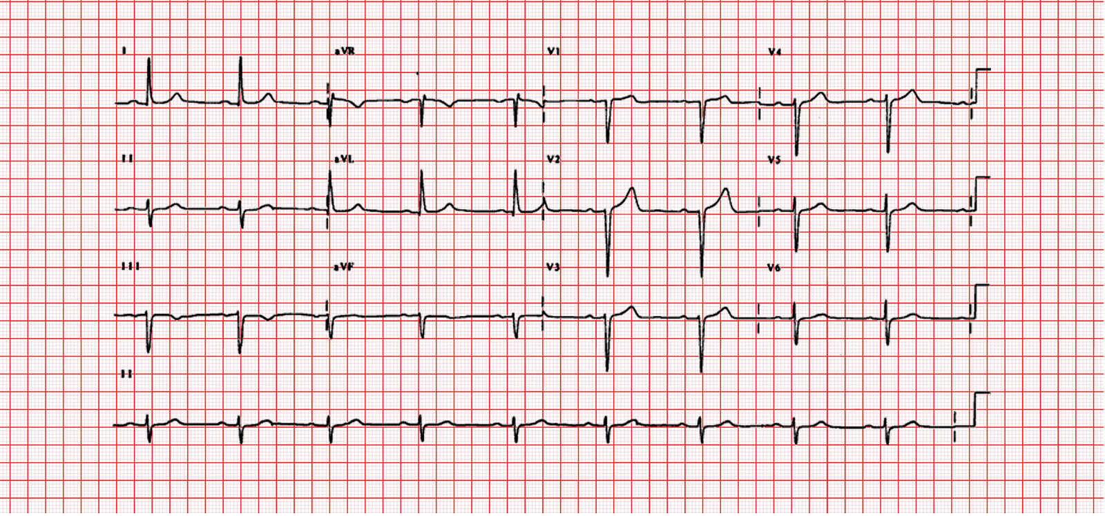 ECG real de 12 derivaciones del caso