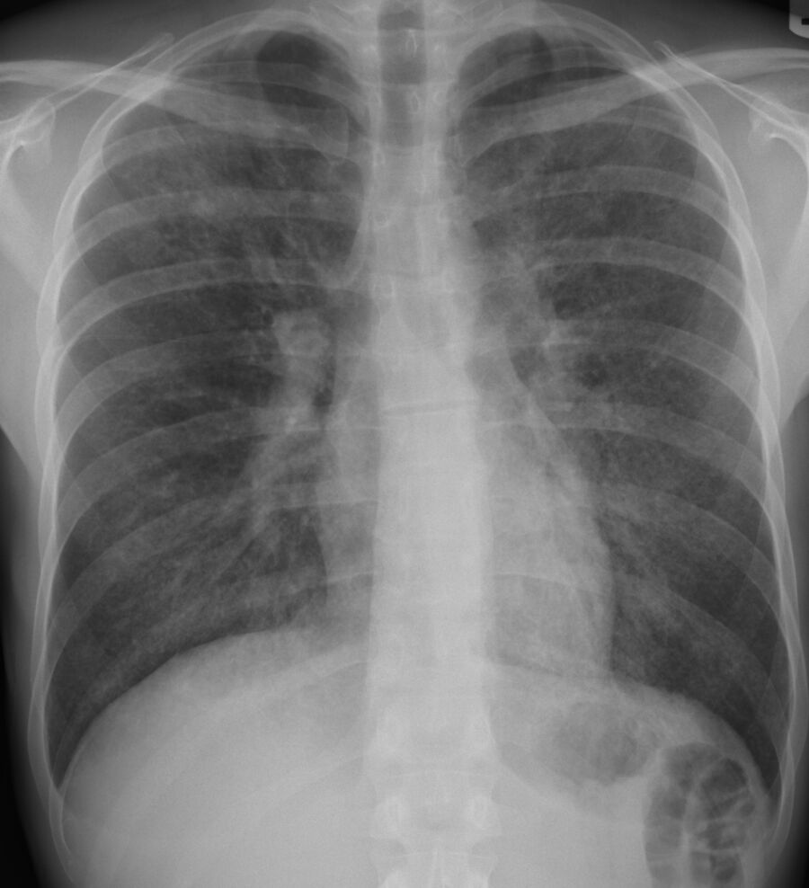 Radiografía de tórax PA real del caso